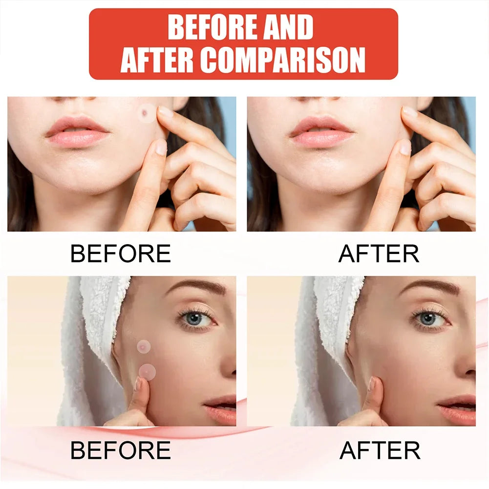 Clear Skin Magic Pimple Patches